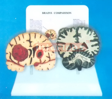 DESK-TYPE, BRAIN MODEL FOR COMPARISION DEMONSTRATING HEALTH MAN THAN SMOKING MAN WITH DESCRIPTION PLATE